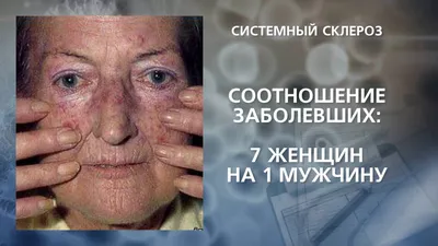 Склеродермия: причины, симптомы и признаки, диагностика и лечение в Москве
