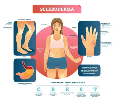 Склеродермия лечение, симптомы и признаки