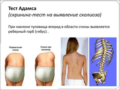 Сколиоз, восстановление и профилактика в Крыму, восстановление позвоночника