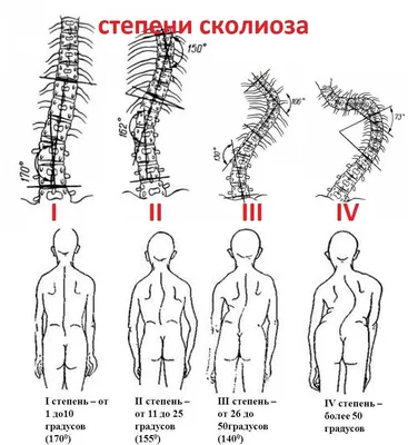 Берут ли в армию со сколиозом – Отвечают юристы по призыву