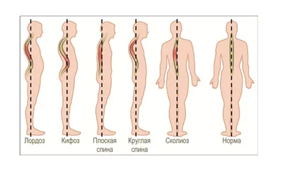 Виды искривления позвоночника у детей и взрослых, Лечение в Москве