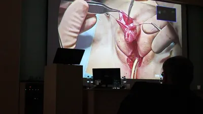 В Сыктывкаре итальянский хирург провел уникальную операцию девочке с  мужским половым органом — Такие дела