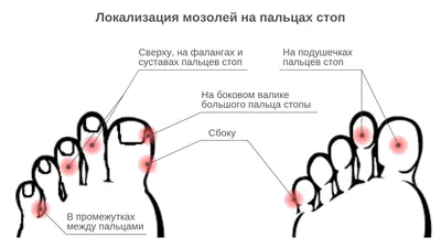 Сезон мозолей» объявляется закрытым: боремся с мозолями на пальцах ног