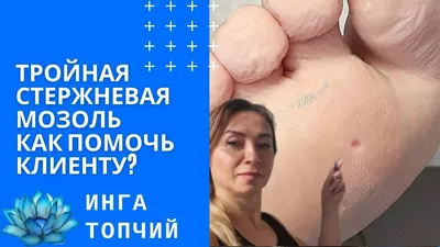 Стержневая мозоль между пальцами. Как лечить? - YouTube