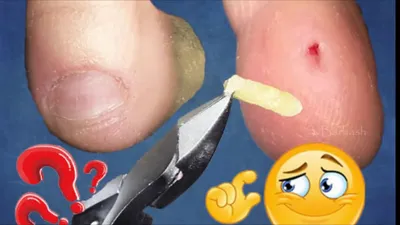 Remove the callus. Deep callus. Pedicure. Removing corns on the legs. DEEP  INVENTION - YouTube