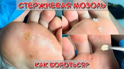 Core callus on the foot 🦶 / Why do calluses appear? - YouTube