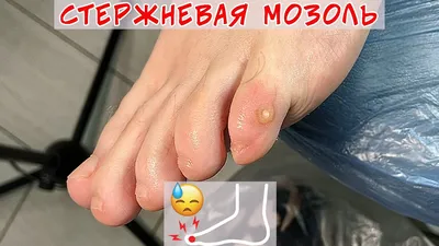 Removal of callus on the little toe - YouTube