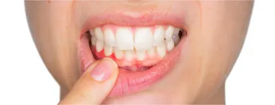 Воспалительные заболевания десен: стоматит, свищ, киста - причины и лечение  Стоматология Dental Way в Москве и Московской области | Dental Way
