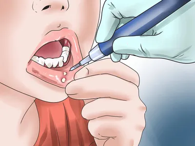 Как лечить стоматит у детей советы опытных стоматологов