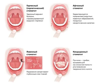 Стоматит у взрослого: от чего появляется и как вылечить — Экспертные статьи  на сайте стоматологии АРТ