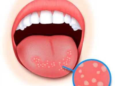 Стоматит на язиці, лікування стоматиту у стоматології на Солом'янці