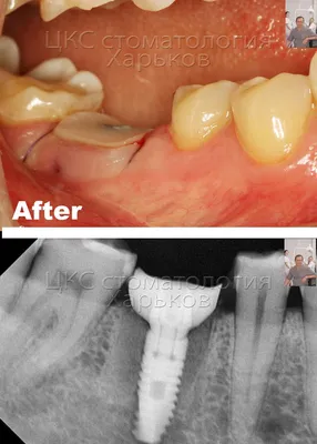Операция установки зубного имплантата без скальпеля и разрезов