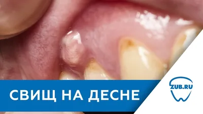 Свищ на десне - причины, симптомы, лечение в Москве - цены, отзывы в  стоматологических клиниках Зуб.ру