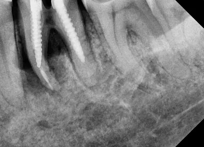 Удаление разрушенного зуба и одномоментная установка имплантата :: Цекс, г.  Харьков