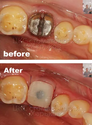 Операция установки зубного имплантата без скальпеля и разрезов