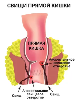 Операция по удалению свища прямой кишки в СПб - сделать иссечение  хронического парапроктита, цены