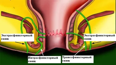 Fistula of rectum - the methods of treatment and what is it? - YouTube