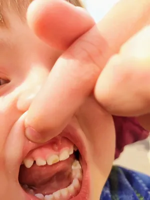 Свищ молочного зуба | Детская и семейная стоматологическая клиника \