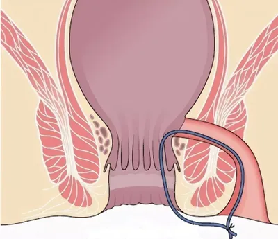 Лечение хронического парапроктита в Хабаровске - Медикъ