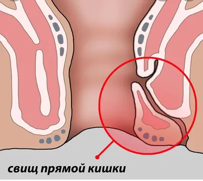 Лечение свища прямой кишки в Ростове по выгодной цене. Свищ прямой кишки-  Doctor-Prof