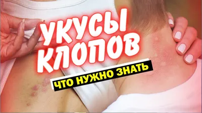 Как выглядят и чем опасны укусы клопов для ребенка