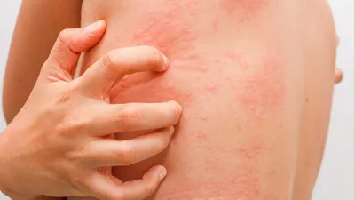 Может ли сыпь на коже быть симптомом коронавируса? - Hi-News.ru