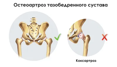 Коксартроз. остеоартрит тазобедренного сустава Лечение без операций в киеве