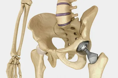 Ревизионное эндопротезирование тазобедренного сустава в Пушкино, цены
