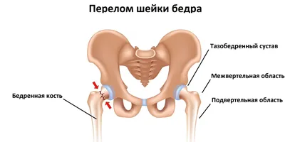 Перелом шейки бедра: как распознать, чем лечить и как долго придётся  восстанавливаться - Лайфхакер