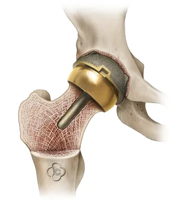 Эндопротезирование тазобедренного сустава — цена в Москве, стоимость  операции в «Центре Спортивной Травмы»