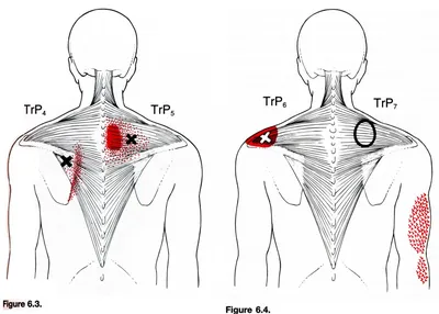 Трапециевидная мышца: анатомия, триггерные точки, тейпирование