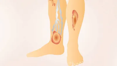 Лечение венозных трофических язв на ногах в Москве | Симптомы, причины и  диагностика заболевания нижних конечностей