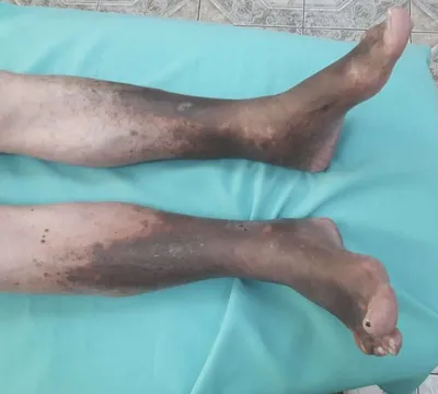 Лечение венозных трофических язв на ногах в Москве
