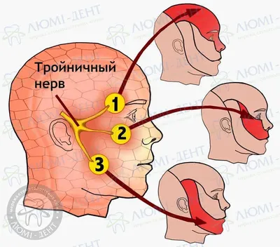 Тройничный Нерв 9 Фото [Чем Снять] Воспаление- ЛюмиДент