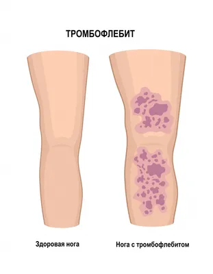 Тромбофлебит - причины появления, симптомы заболевания, диагностика и  способы лечения