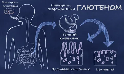 Целиакия (глютеновая энтеропатия): причины, симптомы, лечение | Пробиотики  Нормофлорины – лечение дисбактериоза