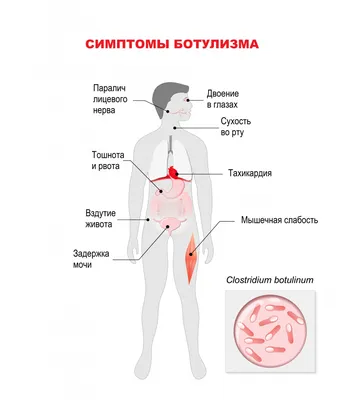 Ботулизм - причины появления, симптомы заболевания, диагностика и способы  лечения