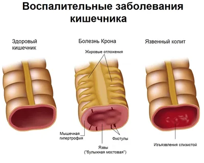 Целиакия (Волгоград): записи сообщества | ВКонтакте