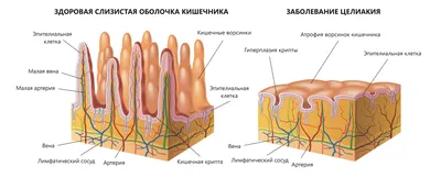 Целиакия (непереносимость глютена) - симптомы, что это за заболевание,  клинические рекомендации