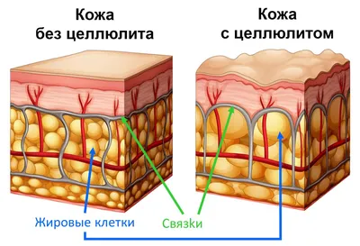 Целлюлит - как он возникает и как от него избавиться Рецепты меню диеты -  Диеты abc