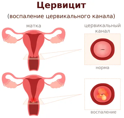 Цервицит: симптомы, диагностика, лечение