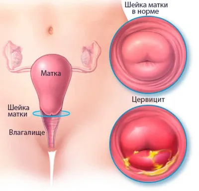 Гонорейный эндоцервицит - что это такое? - arimed.ru