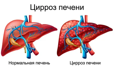 Цирроз печени у курицы фотографии