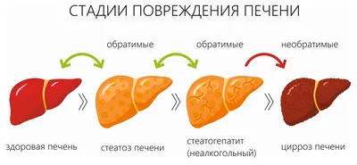 Цирроз печени - симптомы, признаки, стадии и лечение