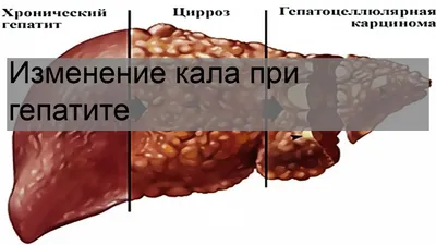 Какой Цвет Кала При Болезни Печени? - [Совет врача] - Клиника А1