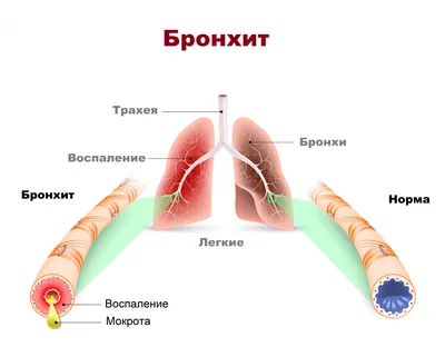 Бронхит - причины появления, симптомы заболевания, диагностика и способы  лечения