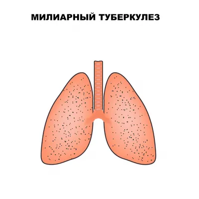 Милиарный туберкулез - причины появления, симптомы заболевания, диагностика  и способы лечения