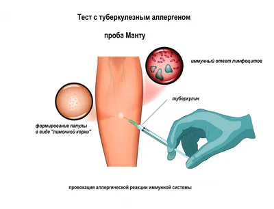 Туберкулез внелегочный - причины появления, симптомы заболевания,  диагностика и способы лечения