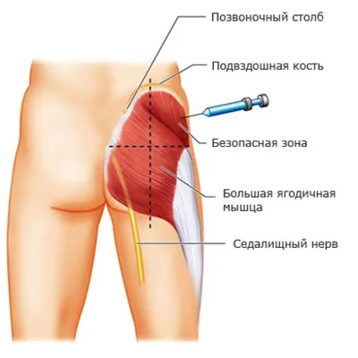 Как сделать укол внутримышечно себе