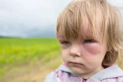 Аллергия на укусы блох у человека: что делать?
